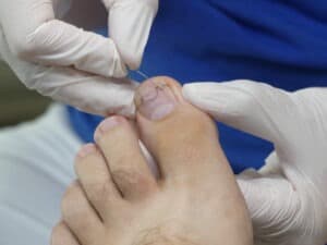 a person wearing gloves and putting a toenail on a toe